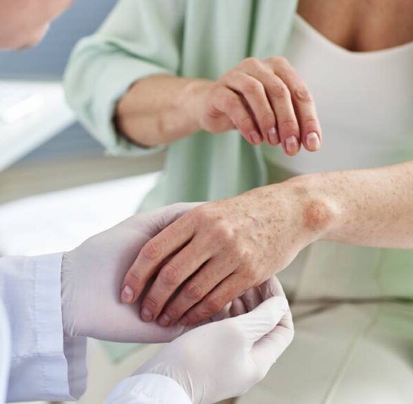 Doktor gleda ruku pacijenta sa psorijazom